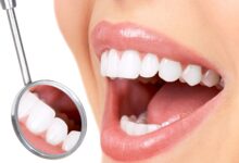 diş beyazlatma yöntemleri 1