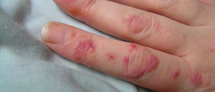 lupus hastalığı parmaklarda yaralara sebepolabilir