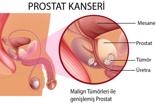 prostat 1