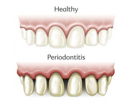periodontitis 2