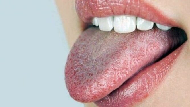 Ağız Kuruluğu Neden Olur ve Belirtileri Nelerdir? 3 agiz kurulugu