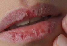 dudak kurulugu dudak catlamasi neden olur1