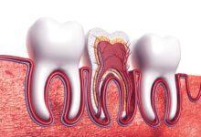 Endodontik