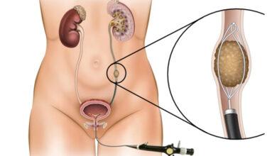 ureter tasi nedir nasil olusur3