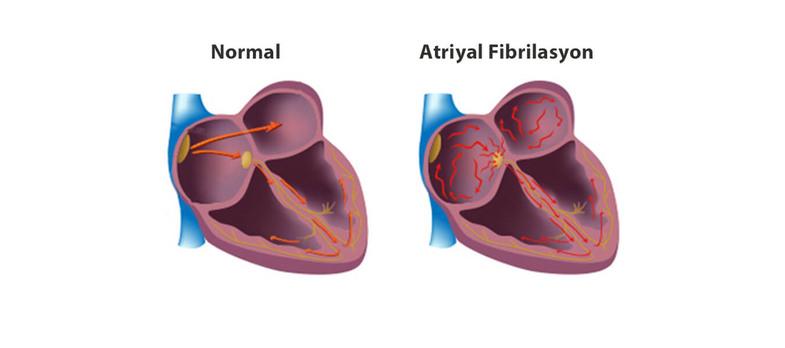 atrial fibrilasyon nedir 4