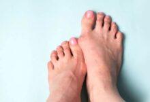 halluks valgus nedir 2