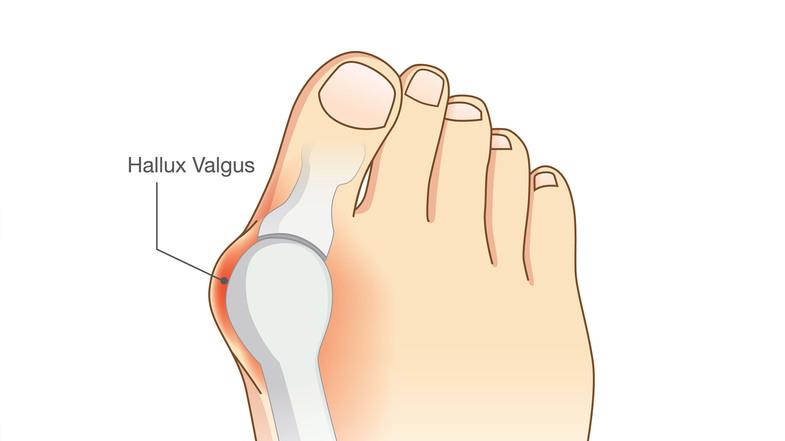 Halluks Valgus