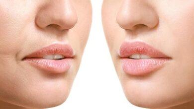 Lip Lift (Dudak Kaldırma) Ameliyatı Nedir?