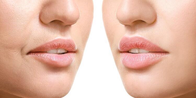 Lip Lift (Dudak Kaldırma) Ameliyatı Nedir?