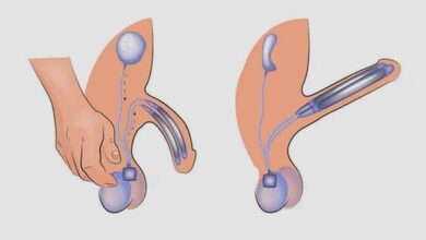 Penis Protezi (Mutluluk Çubuğu) Nedir, Modelleri Nelerdir?