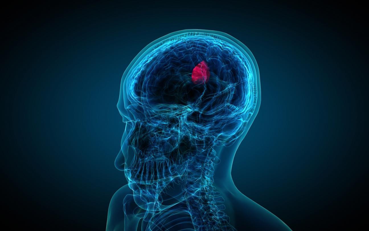 Beyin Lezyonları Nedir? Belirtileri ve Tedavi Yöntemleri Nelerdir?