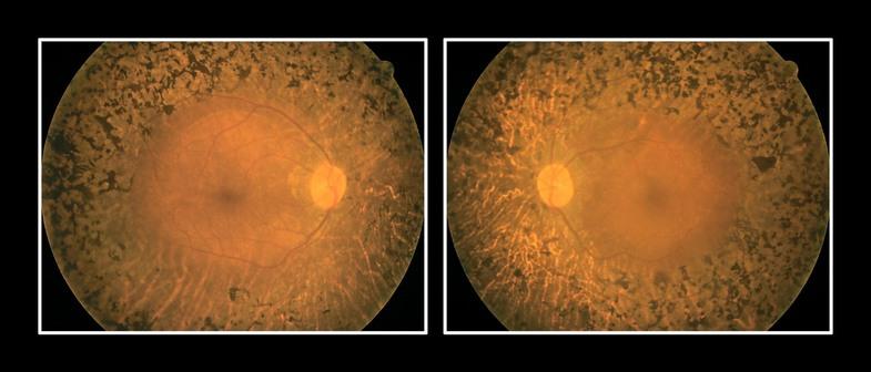 retinitis pigmentosa 2