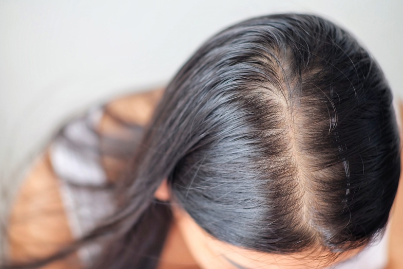 Minoxidil Nedir, Ne İşe Yarar? Minoxidil Saç Çıkarır Mı? 3 minoxidil nedir 2