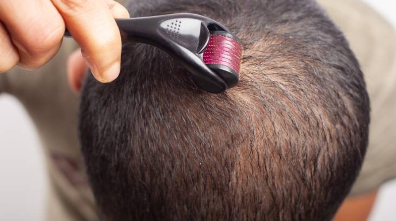 Minoxidil Nedir, Ne İşe Yarar? Minoxidil Saç Çıkarır Mı? 5 minoxidil nedir 3