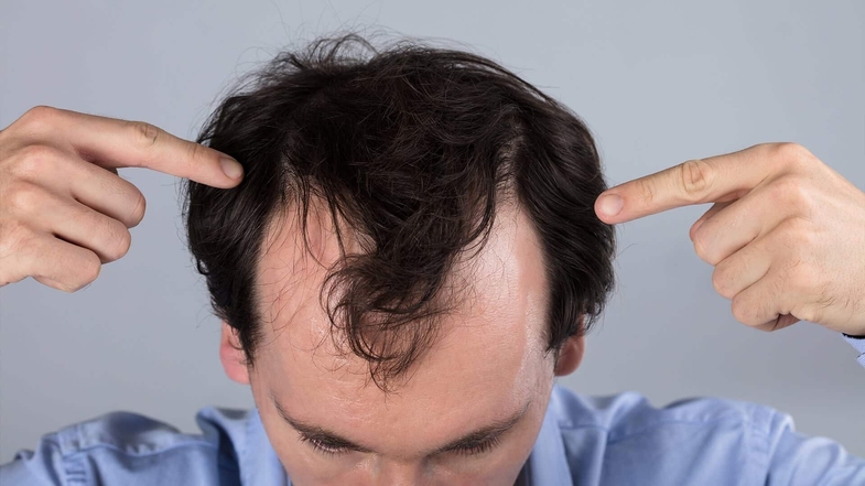 Minoxidil Nedir, Ne İşe Yarar? Minoxidil Saç Çıkarır Mı? 2 Minoxidil